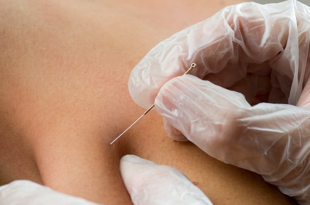 Closeup of dry needling.